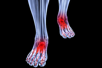 Arthritic foot and ankle care treatment, foot arthritis treatment in the Mississauga, ON L5L 5M5 & North York, ON M2J 2K9 Canada areas