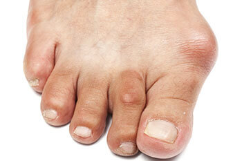Bunions treatment in the Mississauga, ON L5L 5M5 & North York, ON M2J 2K9 Canada areas