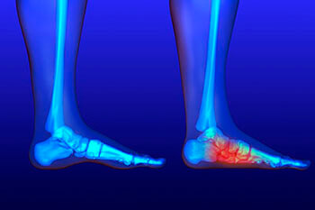 Flat feet and Fallen Arches treatment, Flatfoot Deformity Treatment in the Mississauga, ON L5L 5M5 & North York, ON M2J 2K9 Canada areas
