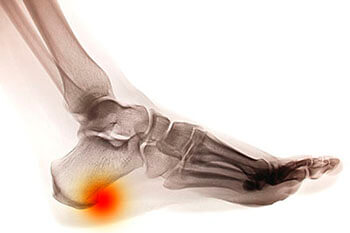 Heel spurs treatment in the Mississauga, ON L5L 5M5 & North York, ON M2J 2K9 Canada areas