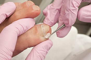 Ingrown toenails treatment in the Mississauga, ON L5L 5M5 & North York, ON M2J 2K9 Canada areas