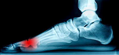 Mortons neuroma treatment in the Mississauga, ON L5L 5M5 & North York, ON M2J 2K9 Canada areas