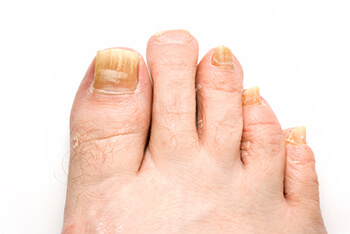 Fungal toenails diagnosis and treatment in the Mississauga, ON L5L 5M5 & North York, ON M2J 2K9 Canada areas