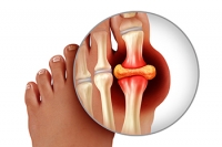 How to Deal With Gout