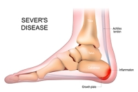 Child and Adolescent Heel Pain May Indicate Sever’s Disease