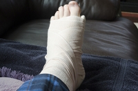 Broken Versus Sprained Feet
