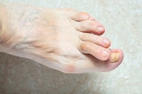 Hammertoe Is a Deformity That May Affect Foot Health