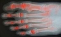 Types of Arthritis in the Elderly
