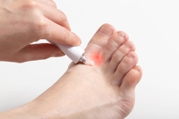 Facts About Athlete’s Foot