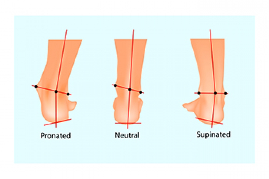 Pronation overpronation deals