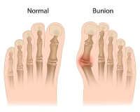 Causes of Bunions
