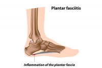 Causes and Risks of Plantar Fasciitis